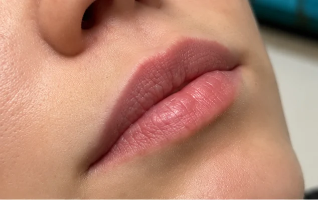 Antes: lábios em vista oblíqua, antes do preenchimento labial (caso 01)
