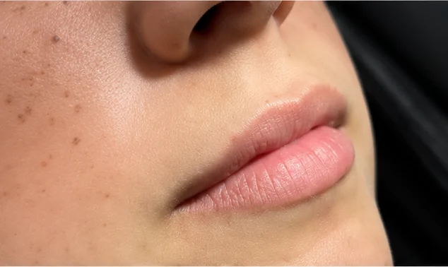Antes: lábios em vista oblíqua, antes do preenchimento labial (caso 02)