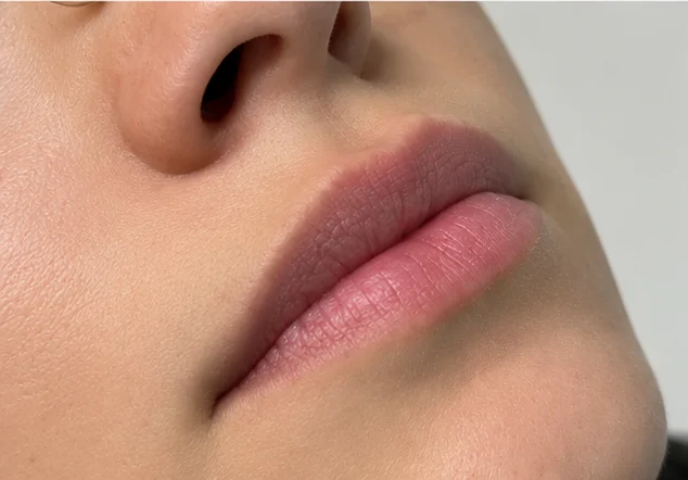 Antes: lábios em vista oblíqua, antes do preenchimento labial (caso 03)