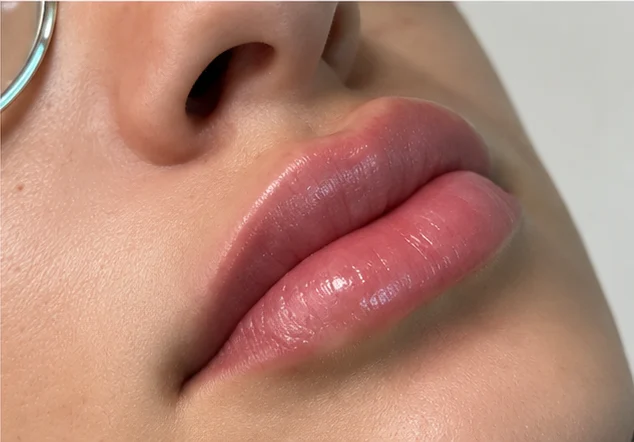 Depois: os mesmos lábios após o preenchimento labial (caso 03)