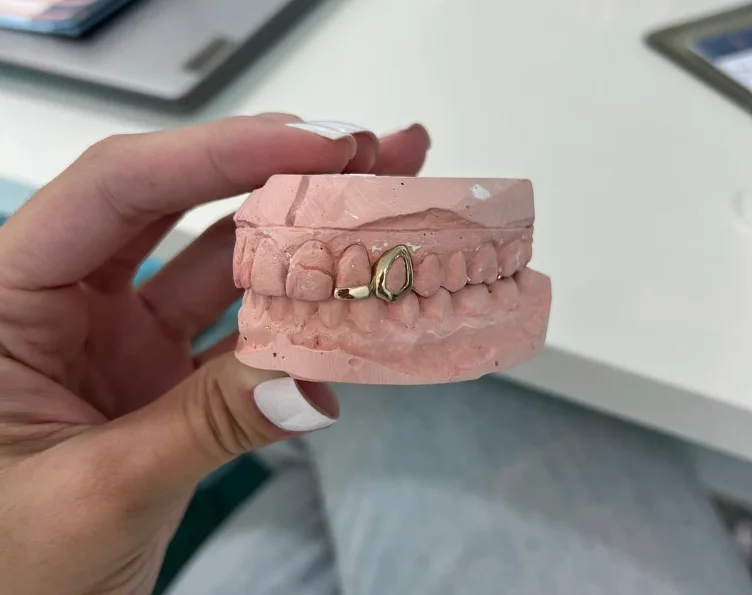 Modelo de gesso da arcada dentária com grillz em ouro sob medida