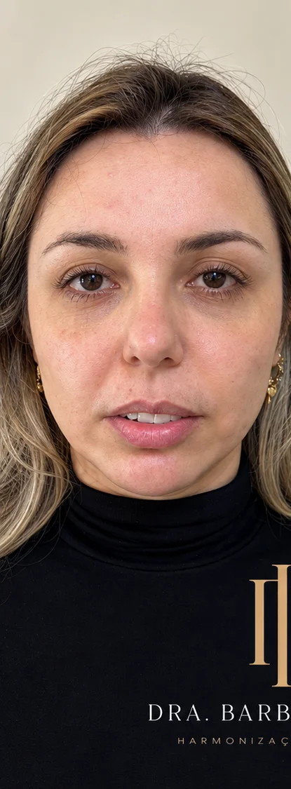 Antes: paciente em vista frontal, antes da harmonização orofacial