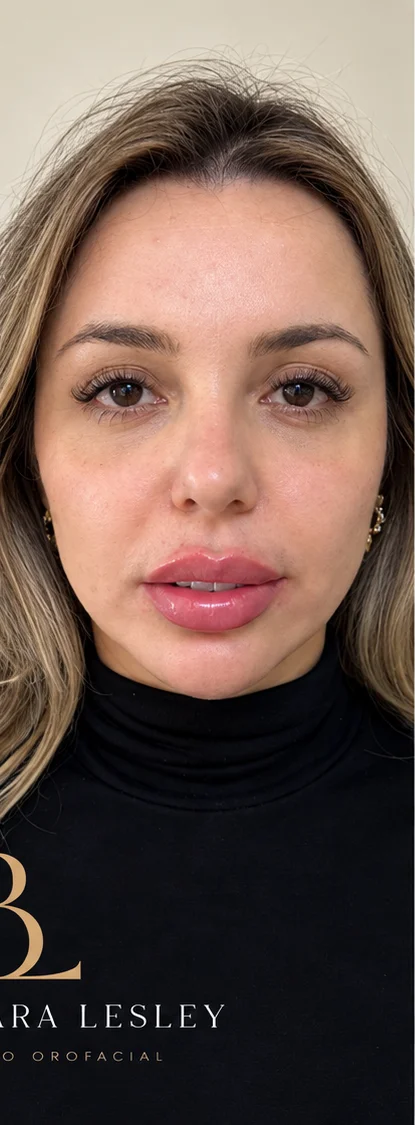 Paciente em vista frontal após harmonização orofacial com a Dra. Barbara Lesley