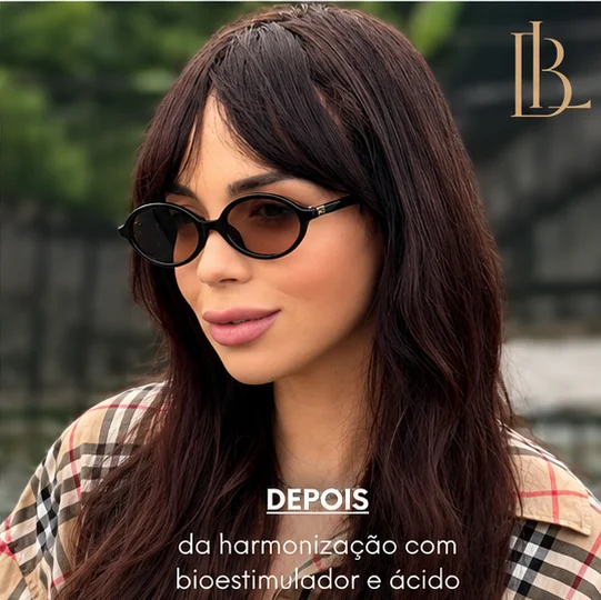 Depois: a mesma paciente de óculos escuros, após a harmonização com bioestimulador e ácido
