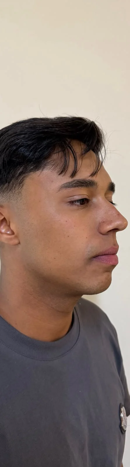 Antes: paciente em perfil, antes da harmonização facial
