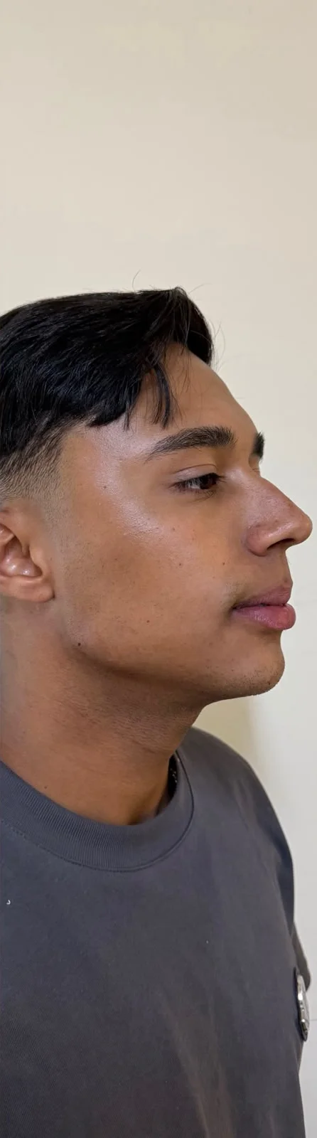 Depois: mesmo paciente em perfil, após a harmonização facial