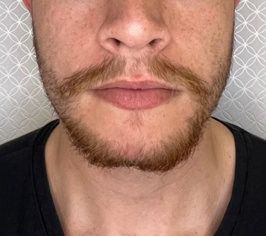 Antes: terço inferior do rosto de paciente com barba, vista frontal