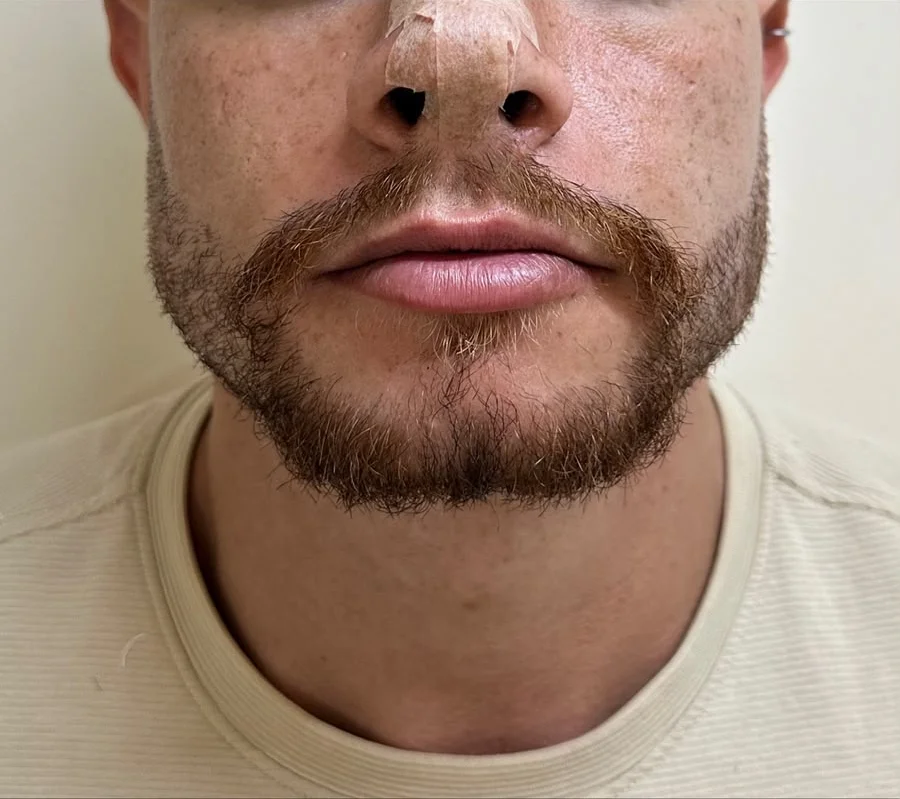Depois: o mesmo paciente com barba, vista frontal após o tratamento